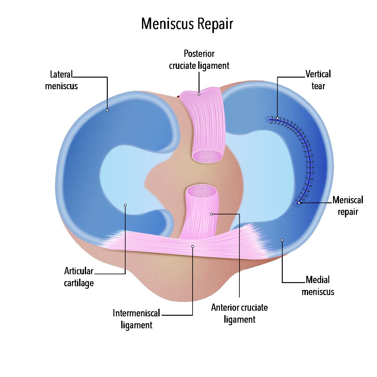Melbourne, Health, When Is Lateral Meniscus Tear Treatment Needed?