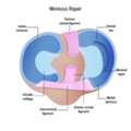 When Is Lateral Meniscus Tear Treatment Needed?