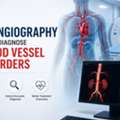 How CT Angiography Helps Diagnose Blood Vessel Disorders