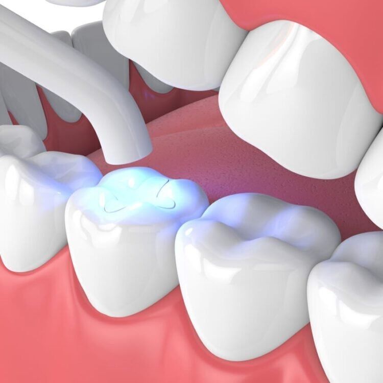 Manchester, Dental, Affordable Composite Teeth Filling Cost Abroad | Meditouring