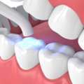 Affordable Composite Teeth Filling Cost Abroad | Meditouring