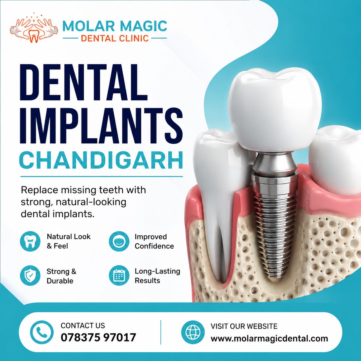Chandigarh, Dental, Best Dental Implants Chandigarh | Molar Magic Dental