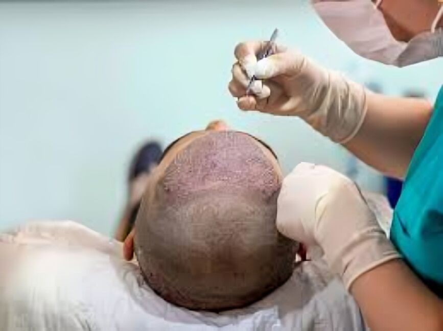 New Delhi, Health, Full Hair, Fair Price &mdash; Hair Restoration Pricing You Can Trust