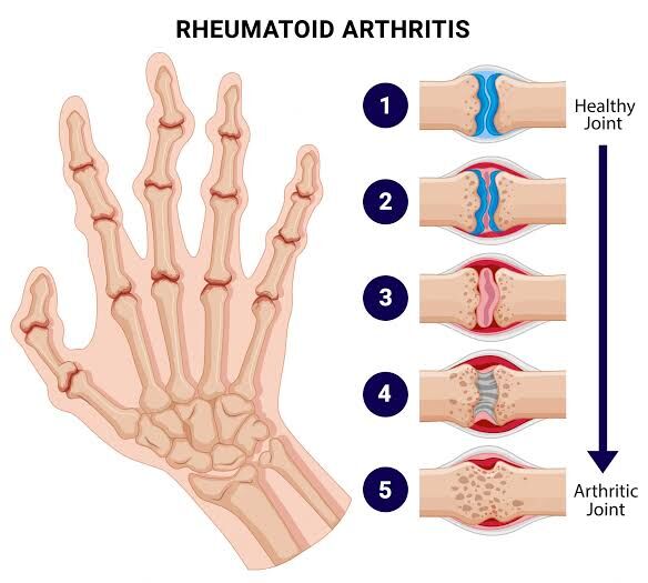 Gurgaon, Businesses For Sale, Rheumatoid Arthritis Treatment In Gurgaon | Expert Physiotherapy For Joint Pain Relief