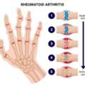 Rheumatoid Arthritis Treatment In Gurgaon | Expert Physiotherapy For Joint Pain Relief