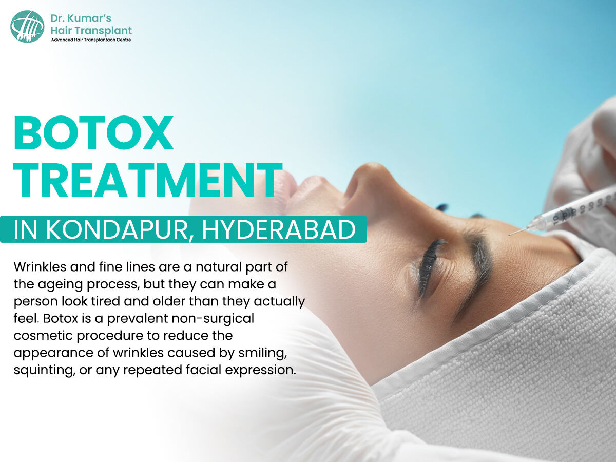 Hyderabad, Health, Advanced FUE Hair Transplant In Hyderabad With Natural Results
