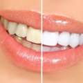 Cosmetic Dentistry In Brampton | Beautiful Smile Makeovers