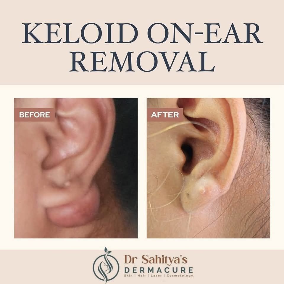 Kurnool, Health, Keloid Treatment In Rajahmundry- Dermacure Clinic