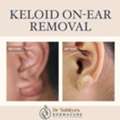 Keloid Treatment In Rajahmundry- Dermacure Clinic