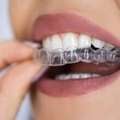 Clear Aligners Brampton | Straighten Your Smile Comfortably