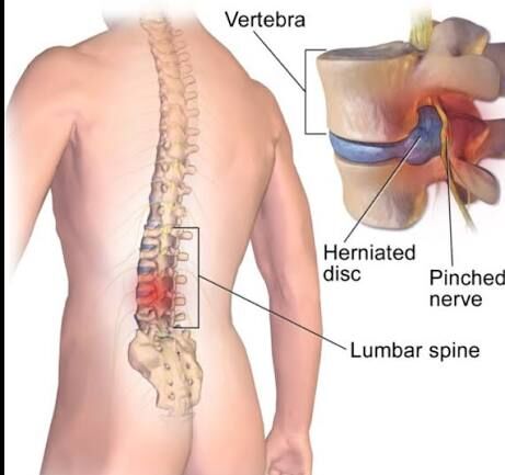 Gurgaon, Businesses For Sale, Spinal Rehabilitation In Gurgaon | Expert Spine Pain & Recovery Physiotherapy