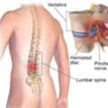 Spinal Rehabilitation In Gurgaon | Expert Spine Pain & Recovery Physiotherapy