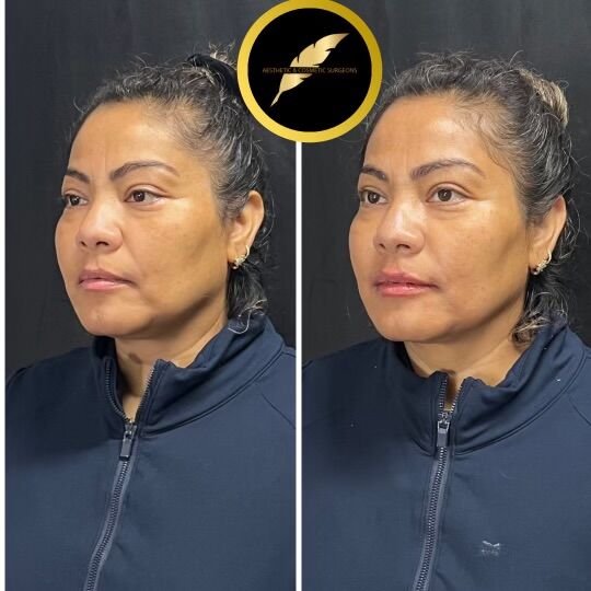 Los Angeles, Health, Facelift Surgery In Los Angeles