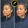 Facelift Surgery In Los Angeles