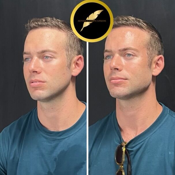 Los Angeles, Health, Facelift Surgery In Los Angeles