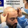 Best Hair Transplant Clinic In Thane | DNA Royal Hair Restoration.