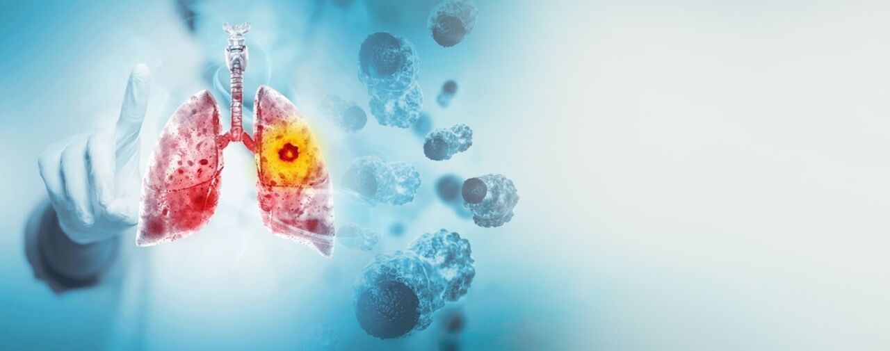 New Delhi, Health, Lung Cancer Treatment In Delhi