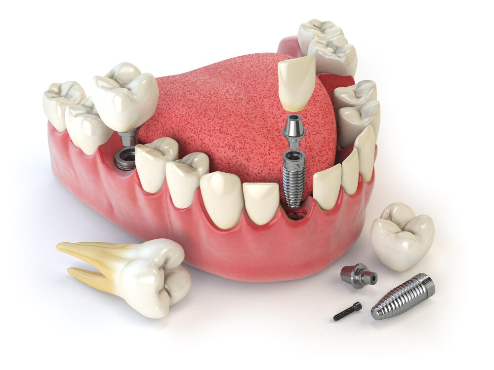 Jaipur, Health, DNG Dental Clinic &ndash; Best Dental Clinic In Jaipur For Complete Dental Care