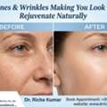 Fine Lines & Wrinkles Making You Look Older? Rejuvenate Naturally