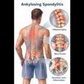 Best Ankylosing Spondylitis Physiotherapy Treatment In Gurgaon | Expert Pain Relief & Reha