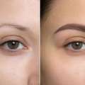 Trusted Eyebrow Surgery Clinic In The UK