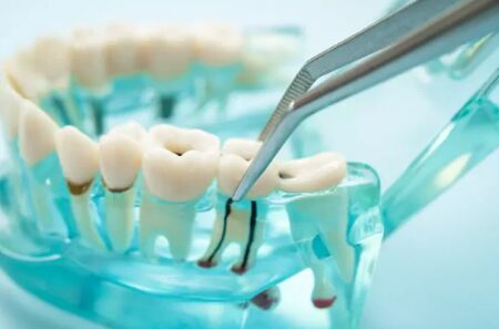 New York, Dental, Expert Surgical Tooth Extraction | Rosedale Smiles