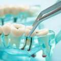 Expert Surgical Tooth Extraction | Rosedale Smiles