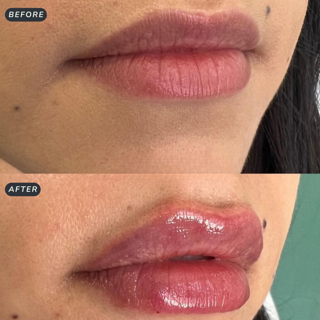 Toronto, Health, Best Lip Augmentation Toronto Treatment