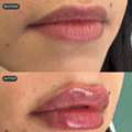 Best Lip Augmentation Toronto Treatment