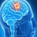 Brain Surgery In Bangalore