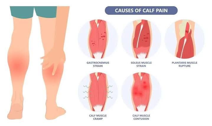 Gurgaon, Businesses For Sale, Calf Strain Treatment In Gurgaon | Expert Physiotherapy For Fast Recovery