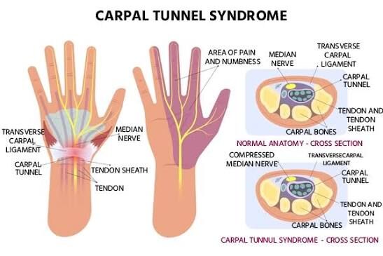 Gurgaon, Businesses For Sale, Carpal Tunnel Syndrome Treatments In Gurgaon | Expert Physiotherapy For Wrist & Hand Pain
