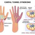 Carpal Tunnel Syndrome Treatments In Gurgaon | Expert Physiotherapy For Wrist & Hand Pain