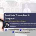 Trusted Hair Transplant Clinic In Gurgaon - SB Trichology