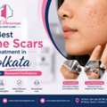 Best Acne Scars Treatment In Kolkata &ndash; Trusted Skin Specialists