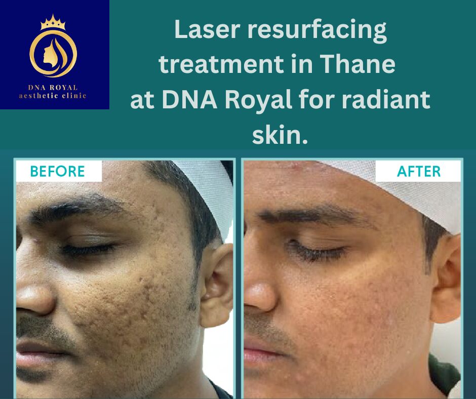 Thane, Fashion & Design, Affordable Laser Resurfacing Treatment In Thane | DNA Royal Experts.