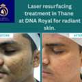 Affordable Laser Resurfacing Treatment In Thane | DNA Royal Experts.