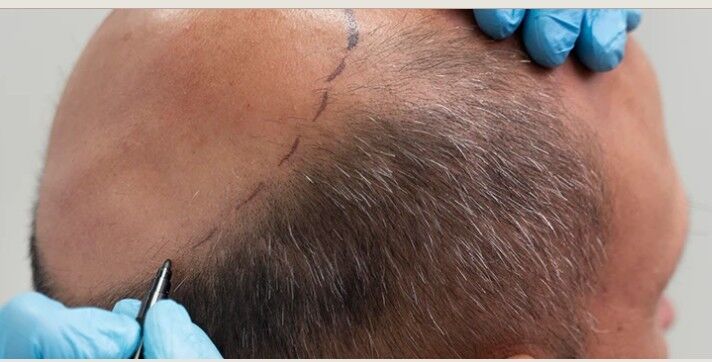 Gurgaon, Health, Hair Transplant In Gurgaon | Personalised Consultation At Aesthetics Redefined