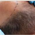 Hair Transplant In Gurgaon | Personalised Consultation At Aesthetics Redefined