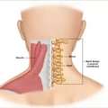 Cervical Spondylosis Treatment In Gurgaon | Expert Neck Pain & Spine Physiotherapy