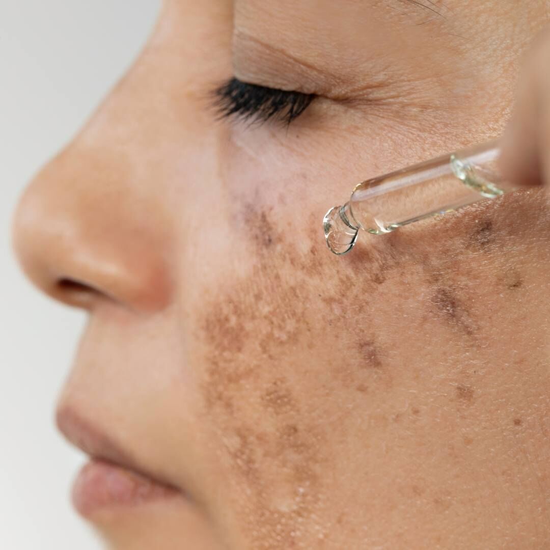 New York, Health, Hyperpigmentation Treatment Tampa For Radiant Skin