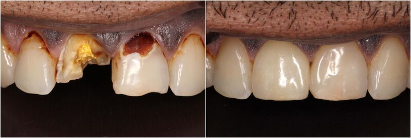 Dublin, Dental, Cavity Fillings At Dublin Metro Dental | Restore Healthy Teeth