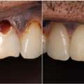 Cavity Fillings At Dublin Metro Dental | Restore Healthy Teeth