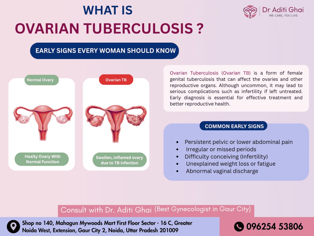 Noida, Health & Beauty Items, Expert Ovarian TB Care By The Best Gynecologist In Gaur City