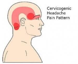 Gurgaon, Businesses For Sale, Cervicogenic Headaches Treatment In Gurgaon | Expert Physiotherapy For Neck-Related Headac