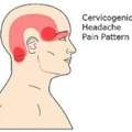 Cervicogenic Headaches Treatment In Gurgaon | Expert Physiotherapy For Neck-Related Headac