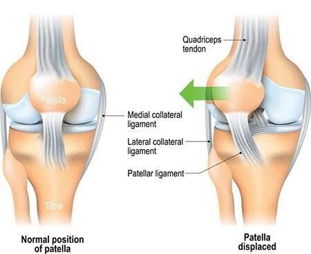 Gurgaon, Businesses For Sale, Chondromalacia Patella Treatment In Gurgaon | Expert Knee Pain Physiotherapy & Rehabilitat