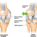 Chondromalacia Patella Treatment In Gurgaon | Expert Knee Pain Physiotherapy & Rehabilitat