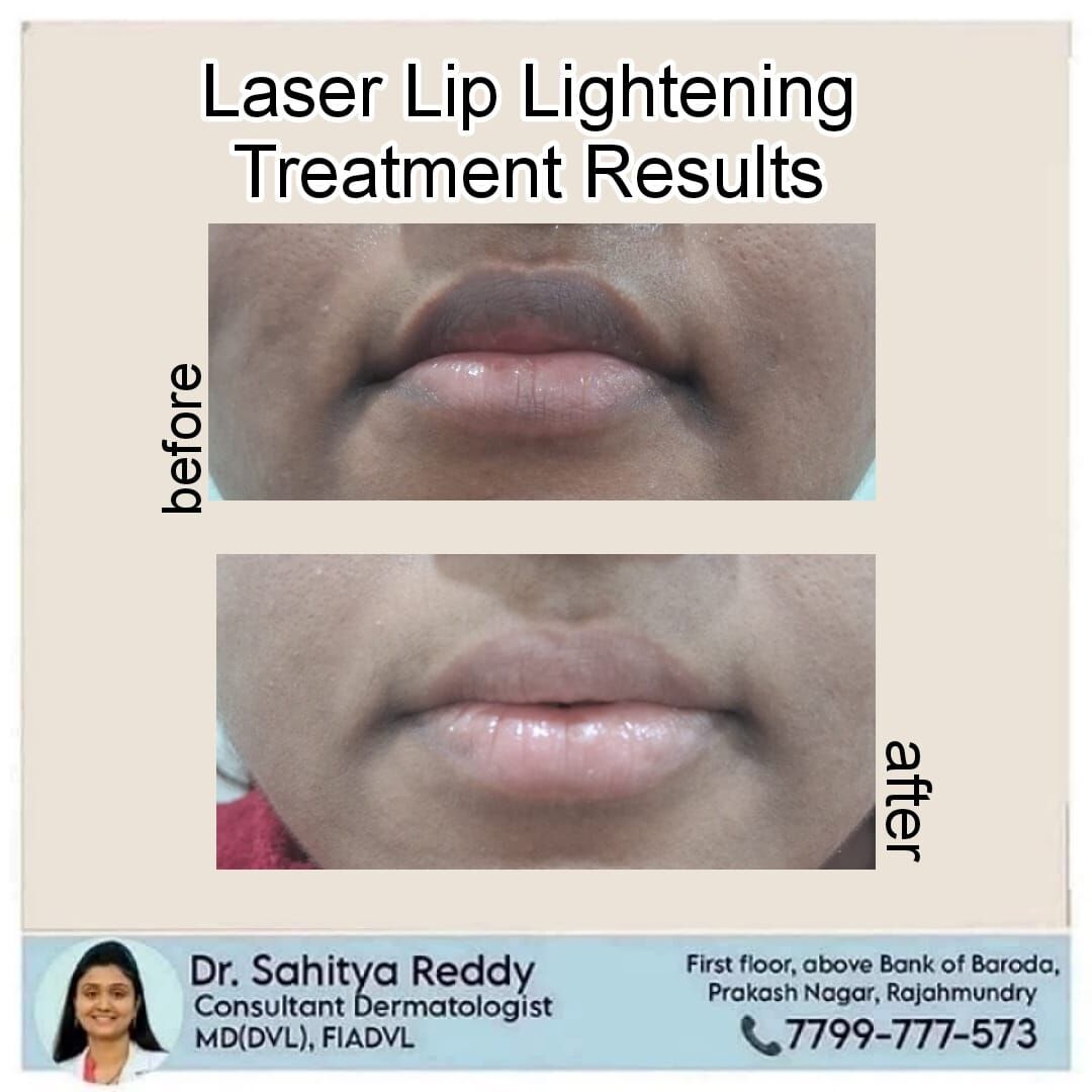 Kurnool, Health, Laser Lip Lightening Treatment - Dr Sahitya Reddy