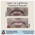 Laser Lip Lightening Treatment - Dr Sahitya Reddy